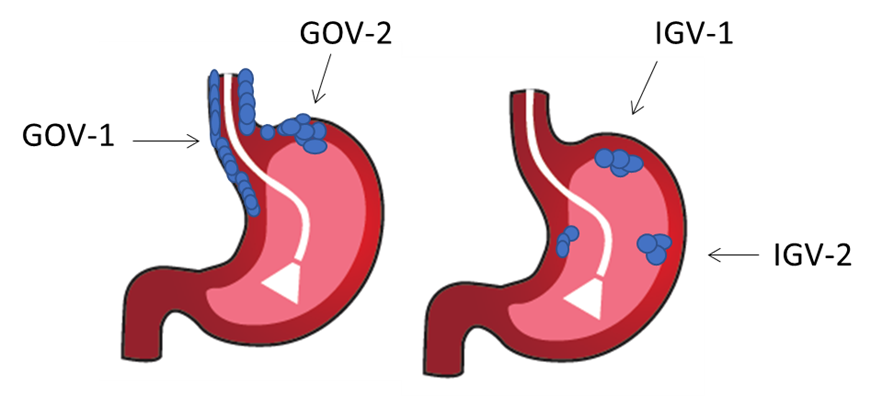 Figure 1. Sarin Classification of Gastric Varices