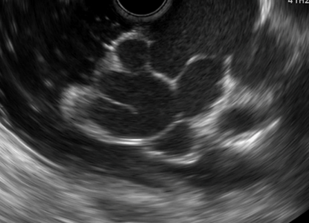 Figure 3 EUS-guided haemostasis in GVB