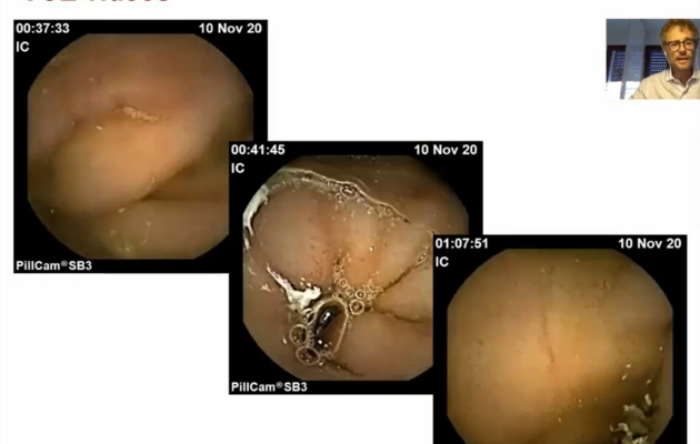small-bowel-endoscopy.png